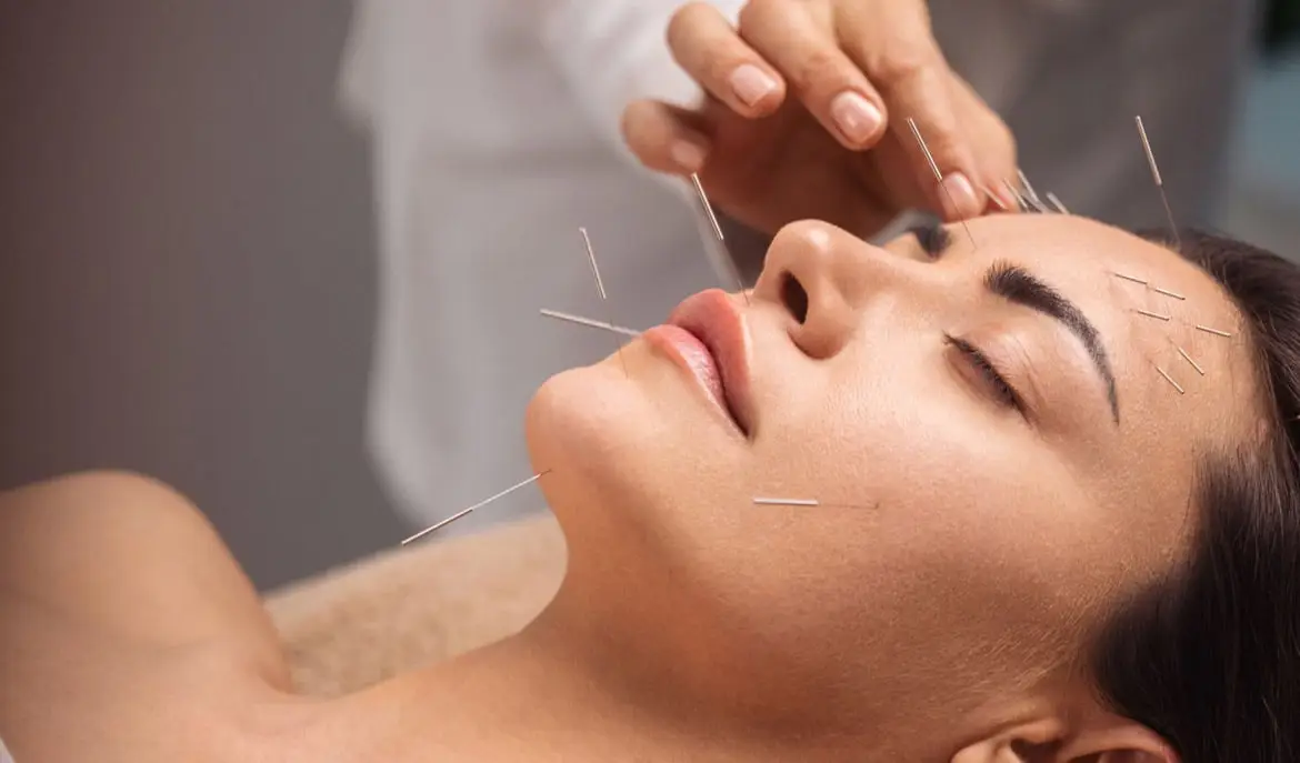 Acupuncture Treatment