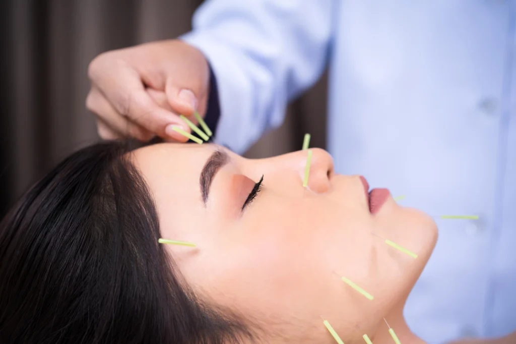 Acupuncture Care in Brampton